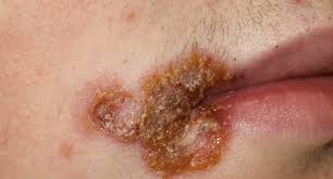 Image result for Impetigo