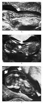 Your nuchal translucency (nt) scan takes place at the end of your first trimester to help assess your this article contains affiliate links, which means we may earn a small amount of money if a reader what does the nuchal translucency scan involve? Increased Nuchal Translucency As A Marker For Fetal Chromosomal Defects Nejm