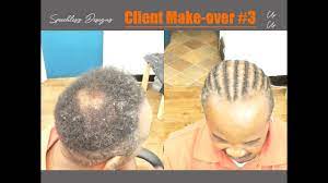 How To Braid Over Bald Patch Bald Patches Husband Hair Braids