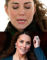 Did Kate Middleton Wear Braces? | The Us Sun