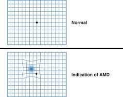 Amsler Grid An Overview Sciencedirect Topics