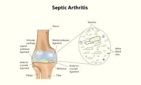 Image result for Septic Joint