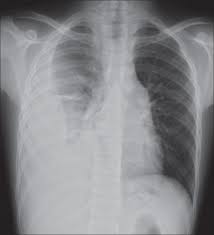 Necrotizing pneumonia (np), also known as cavitary pneumonia or cavitatory necrosis, is a rare but severe complication of lung parenchymal infection. Complicated Pneumonia In Children The Lancet
