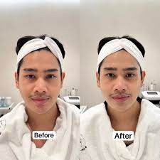 ✨ 𝐒𝐇𝐀𝐍𝐆𝐇𝐀𝐈 𝐓𝐇𝐑𝐄𝐀𝐃 𝐋𝐈𝐅𝐓 9D facelift ✨ 35 years old fascia  lift