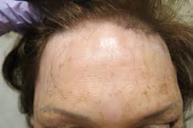 Dermatomyositis is a rare inflammatory disease that primarily causes skin rashes and muscle weakness. Alopecias In Lupus Erythematosus Lupus Science Medicine
