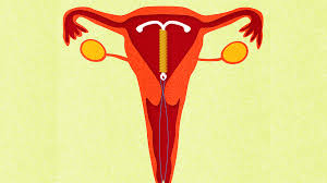 If the string feels longer or shorter than you. When Is It Ok To Get Your Iud Removed Self