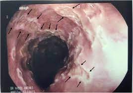 Esophagitis is when the lining of your esophagus becomes irritated and inflamed. Epigastric Pain Associated With Herpes Esophagitis Case Report Bmc Infectious Diseases Full Text