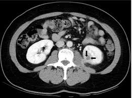 Image result for Perinephric Abscess