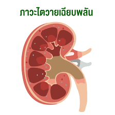 ภาวะไตวายเฉียบพลัน (acute kidney injury, aki) หมายถึง ภาวะที่ไตมีการเสื่อมหน้าที่ลงอย่างรวดเร็วในระยะเวลาเป็นวัน โดยมีลักษณะข้อใดข้อ. à¸­à¸¢ à¸²à¸¡à¸­à¸‡à¸‚ à¸²à¸¡à¹‚à¸£à¸„à¹„à¸•à¹ƒà¸™à¸ª à¸•à¸§ à¹€à¸¥ à¸¢à¸‡ Best Equipment Center Co Ltd Bec