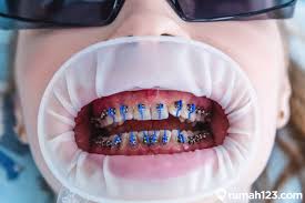 Maybe you would like to learn more about one of these? Ingin Pasang Kawat Gigi Simak Dulu Harga Pasang Behel Terbaru 2020 Rumah123 Com