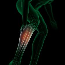 Image result for periostitis