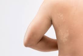 Dry discoid eczema (irritable, generally scattered on trunk and/or limbs) guttate psoriasis (red scaly plaques, look for psoriatic lesions elsewhere) idiopathic guttate hypomelanosis (affects shins and forearms, due to photoageing) pityriasis alba (large patches on face and upper arms) Tinea Versicolor Causes Symptoms Diagnosis Treatment
