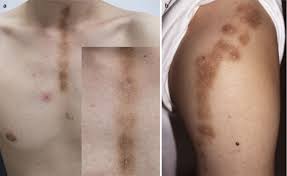 Image result for Diffuse Hyperpigmentation