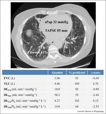 Image result for Diffusing Capacity