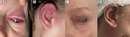 Image result for Relapsing Polychondritis