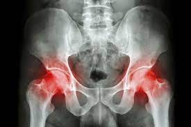 Other symptoms of bone cancer include a lump (that may feel soft and warm) in the arms, legs, chest, or pelvis; Bone Cancer Symptoms Health Hearty
