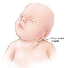 Image result for Positional Head Deformity