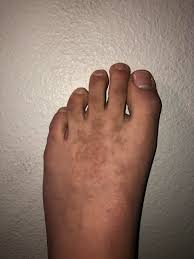 Image result for brown patches on the feet