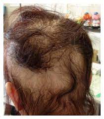 This is why hair coloring instructions tell you to do a skin test first, to ensure hair loss may also be caused by fungal infections, some medications, and undiagnosed medical conditions. Severe Hair Loss Of The Scalp Due To A Hair Dye Containing Para Phenylenediamine