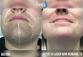 It's seen as a longer. Laser Hair Removal Nw Calgary Fresh Laser Skin Studio