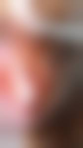 Vestibular Papillomatosis Causes, Smptoms, Diagnosis & Treatment