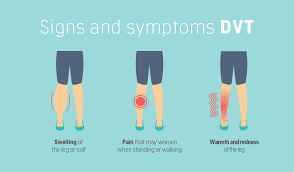 Most often, they form in the legs, arms, or groin. Signs And Symptoms Of Deep Vein Thrombosis Avis Hospital