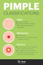 How To Get Rid Of Pimples The Secrets To Clear Skin Natural Acne Treatment Pimple Treatment Natural Acne