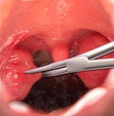 Image result for Tonsillectomy