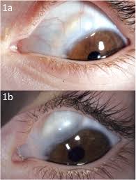 Image result for lesion sclera