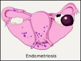 Endometriosis has also been linked to adverse pregnancy outcomes. Endometriosis And Chocolate Cysts Women Health Info Blog Chocolate Cyst Endometriosis Cysts