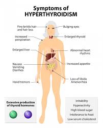 Thyroid disease is a medical condition that affects the function of the thyroid gland. Overactive Thyroid Hyperthyroidism What Are The Symptoms