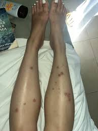 Image result for flea bites