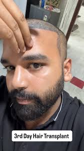 Luxury Hair Restoration