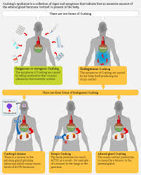 Cushing S Syndrome Infographic Adrenals Eu