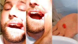 If you have bleeding after this gauze is removed, fold another piece of clean gauze into a pad. Diy Dentist Man Removes His Own Wisdom Tooth Daily Mail Online