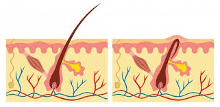eingewachsene barthaare vorbeugen und sanft entfernen