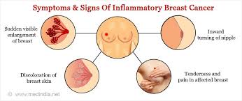 Image result for Inflammatory breast cancer