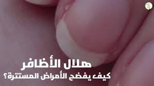 فطريات الأظافر، والمعروفة طبيًا باسم الفُطارٌ الظُفُرِيّ onychomycosis، هي مشكلة محرجة يمكن أن يكون من الصعب علاجها. Msn Arabia ÙÙØ§Ù Ø§ÙØ£Ø¸Ø§ÙØ± ÙÙØ¶Ø­ Ø§ÙØ£ÙØ±Ø§Ø¶ Ø§ÙÙØ³ØªØªØ±Ø© Facebook
