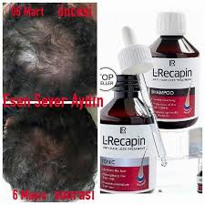 Saclarini Geri Isteyenler Lr Lr Lrdegerkatar Lrizmir Uyelik Kazanc Saglik Serox Sedef Egzama Erkeksac Aloevera