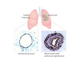 They love frolicking around in the cold and the snow, bless their hearts. Lung Cancer Triggers Pulmonary Hypertension Max Planck Gesellschaft