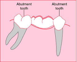 369,672 likes · 209,938 talking about this. Angulated Abutment Definition Of Angulated Abutment By Medical Dictionary