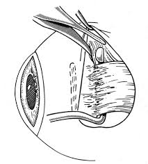 Image result for Blunt Dissection