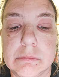 What can help with a persistent body rash?