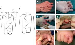 Image result for Syndactyly