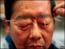 Acupuncture and the Brain