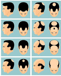 Must listen to this informative video and don't forget to share. Hair Transplantation Kolors Healthcare India