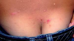 Image result for scabies in the groin area