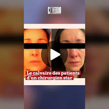 Rhinoplastie ratée : le témoignage de Marilou