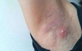 Deodorants are classified as cosmetic agents by the food and drug administration (fda). 6 Reasons For Armpit Pimples How You Can Treat Them Skinkraft