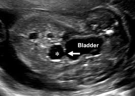 Also, endometriosis can cause cysts on the ovaries that may appear to be pelvic masses similar to ovarian cancer. Fetal Ovarian Cysts Review Of Imaging Spectrum Differential Diagnosis Management And Outcome Radiographics